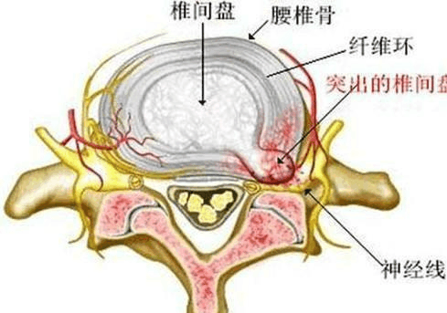 腰椎間盤突出癥的最新研究進(jìn)展與治療策略綜述